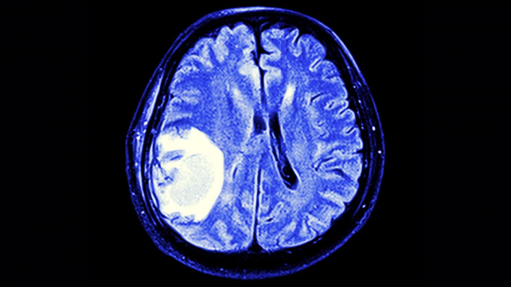 'Frozen' Immune Cells Can Be Reactivated to Fight Brain Tumors