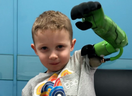 UK Boy First to Receive a Prosthetic Arm Above the Elbow