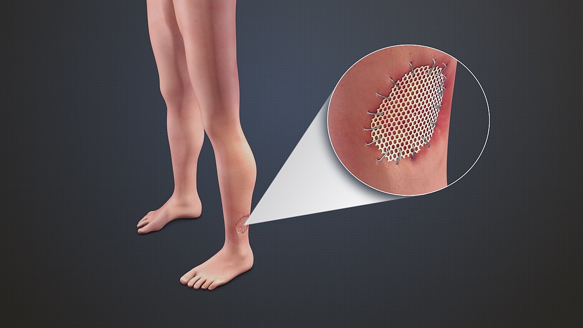 Skin grafting Skin grafting
