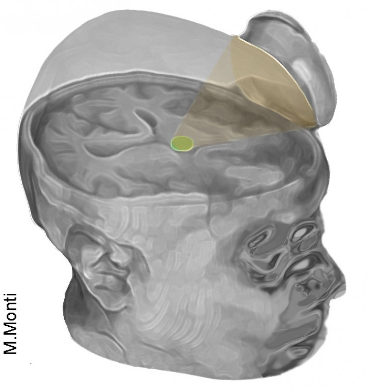 Scientists Use Ultrasound to Jumpstart Two Comatose Patients' Brains Scientists Use Ultrasound to Jumpstart Two Comatose Patients' Brains