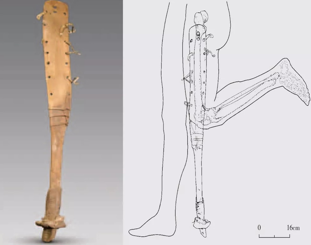 prosthetics in history china