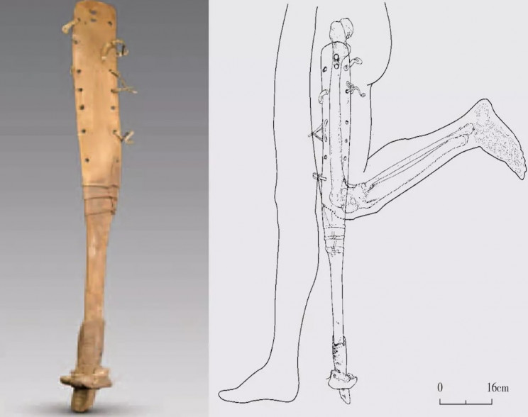 prosthetics in history china