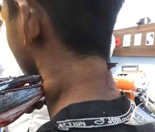 Needlefish lodged in the neck of a teenage boy.