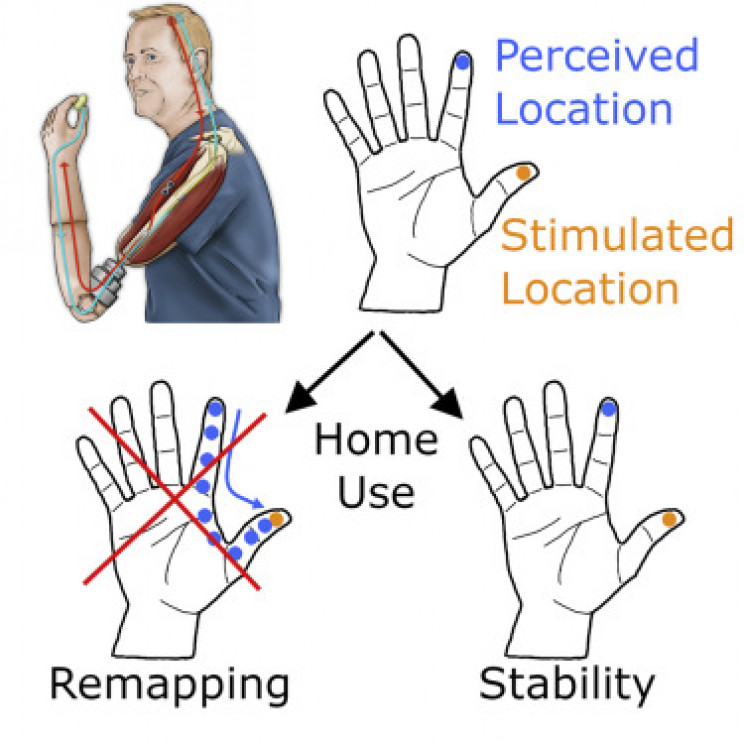 brain prosthetic adaptation