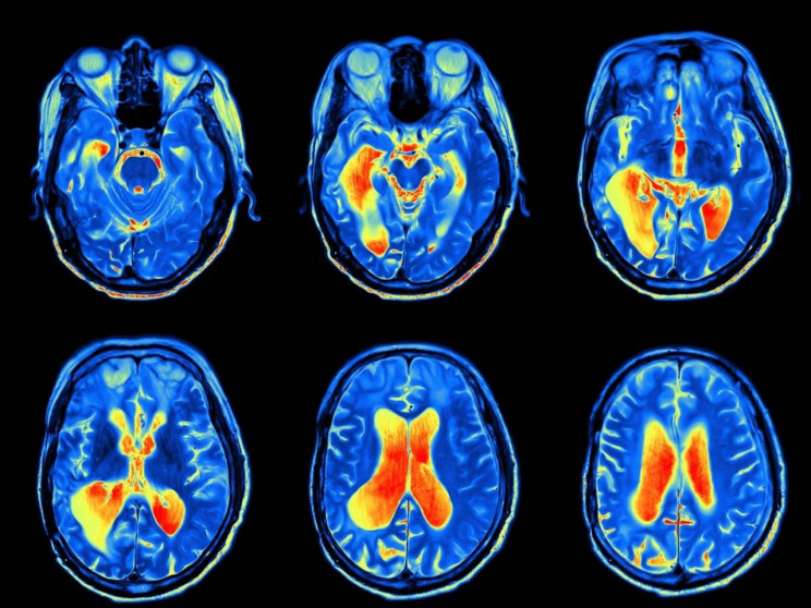 Neuralink and Elon Musk's Adventures in Brain Hacking Explained (Maybe)