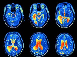 Neuralink and Elon Musk's Adventures in Brain Hacking Explained (Maybe)