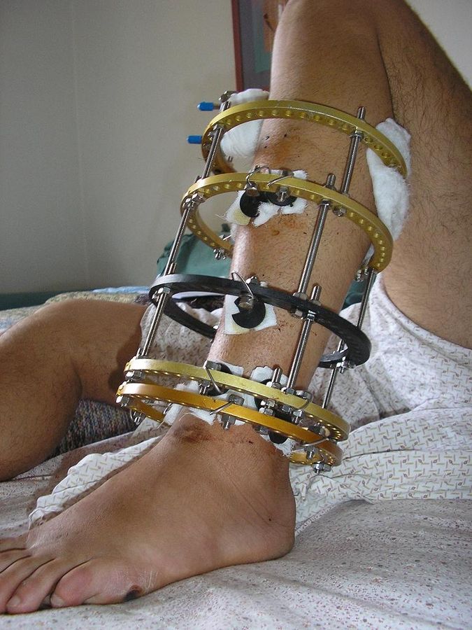 Ilizarov apparatus Ilizarov apparatus