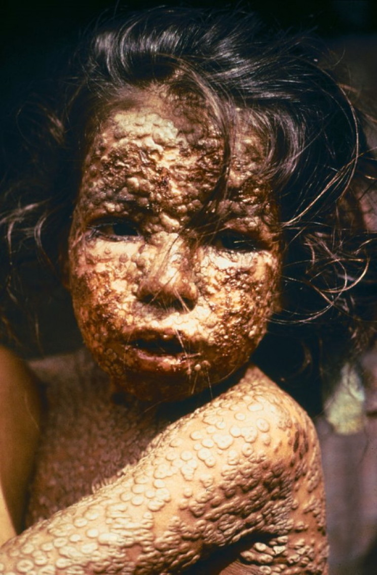 Bangladeshi child with smallpox Bangladeshi child with smallpox