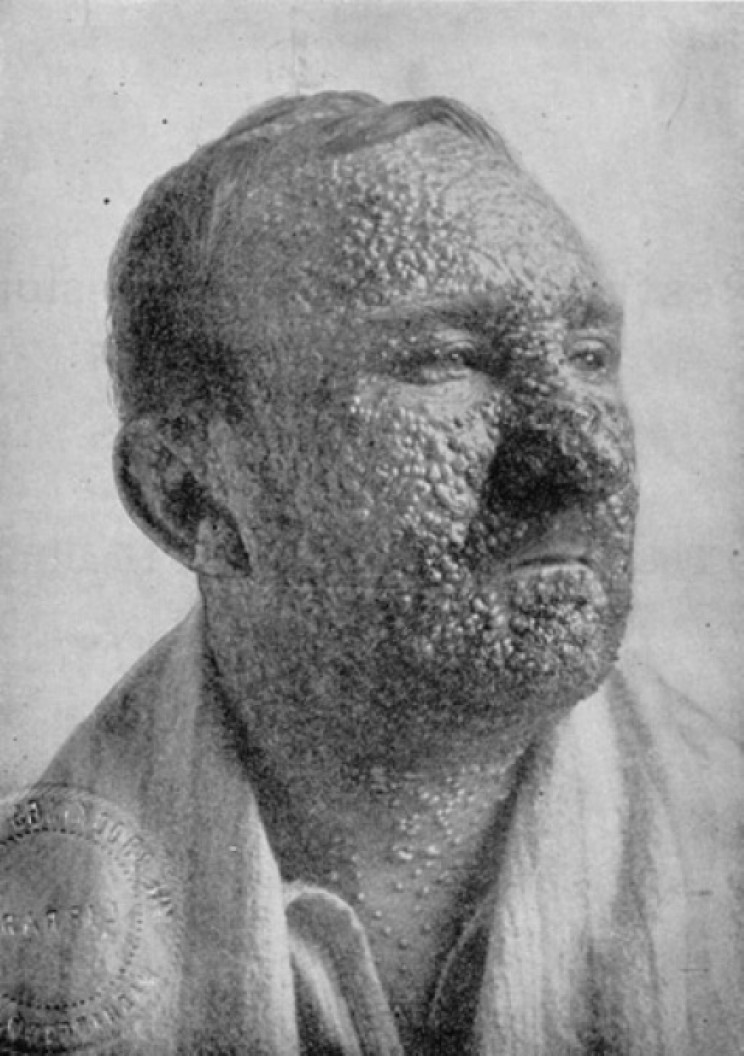 Illinois man in 1912 with smallpox Illinois man in 1912 with smallpox