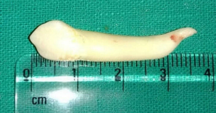 Indian Dentist Pulls Out World's Longest Known Tooth, Breaking Previous Record