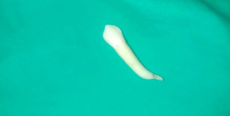 Indian Dentist Pulls Out World's Longest Known Tooth, Breaking Previous Record Indian Dentist Pulls Out World's Longest Known Tooth, Breaking Previous Record