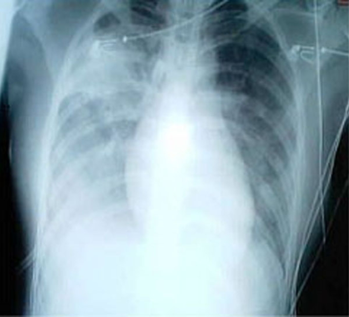 Chest x-ray of patient with SARS Chest x-ray of patient with SARS
