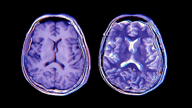 COVID-19 Survivors Literally Lose Gray Matter and Other Brain Tissue