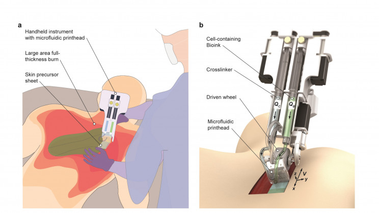 Handheld Device "Prints" New Skin onto Serious Burn Victims Handheld Device "Prints" New Skin onto Serious Burn Victims