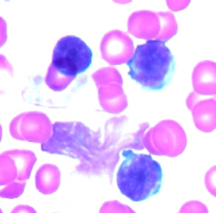 leukemia treatment breakthrough
