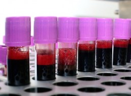 Enzymes That Convert 'A' Blood Type to Universal 'O' Type Discovered