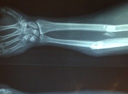 New Medical Device Could Revolutionize Bone Fracture Care