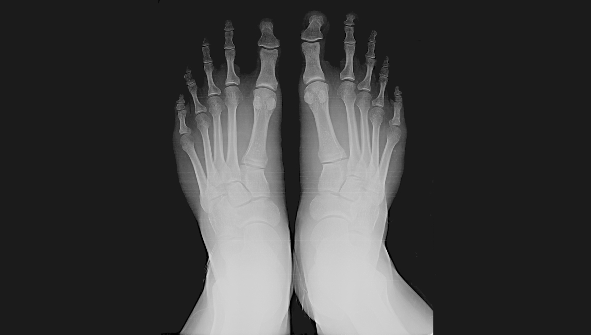 The Era of the ShoeFitting Fluoroscope and the Radiation It Caused