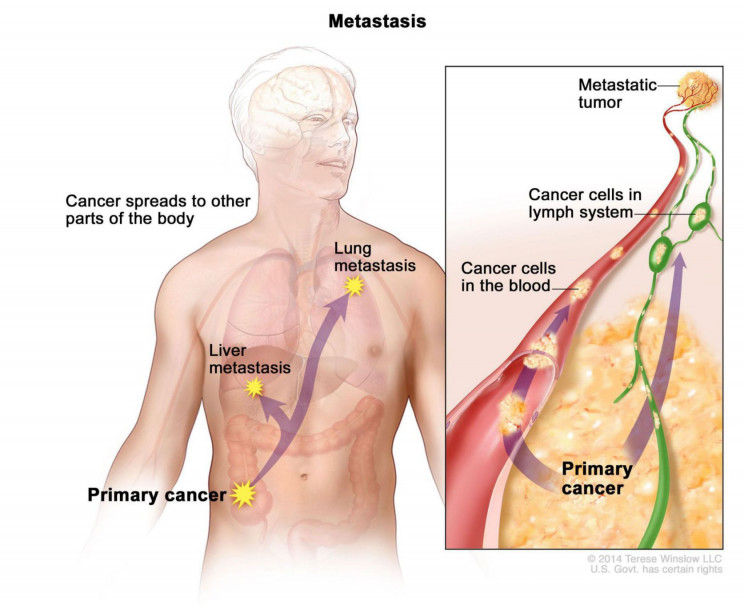 early radiologists diseases metastasis