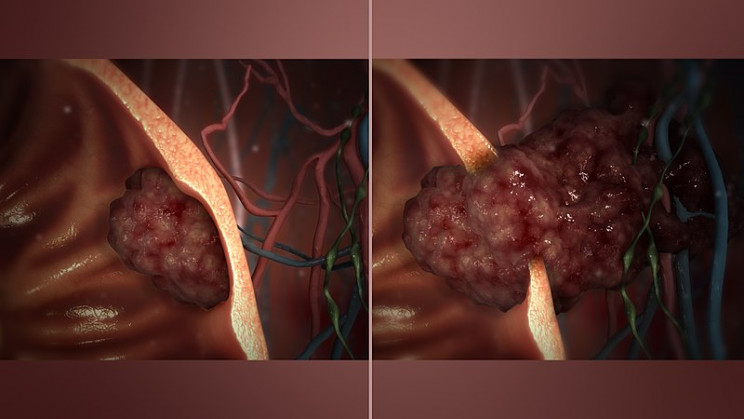 early radiologist health problems tumor