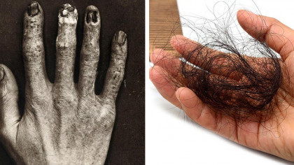 7 Horrible Health Problems and Deformities Suffered by Early Radiologists and Technicians