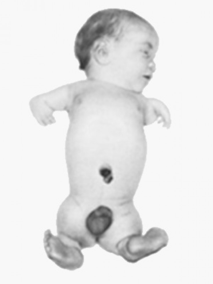 Thalidomide-caused birth defects Thalidomide-caused birth defects