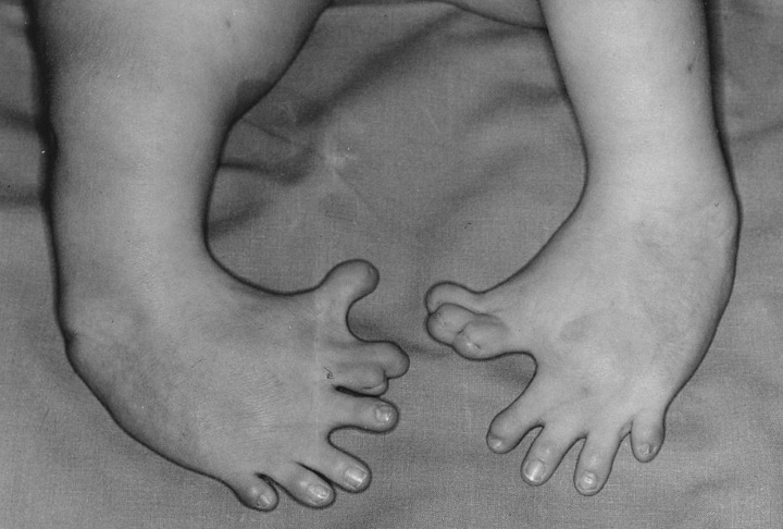 Thalidomide-caused birth defects Thalidomide-caused birth defects