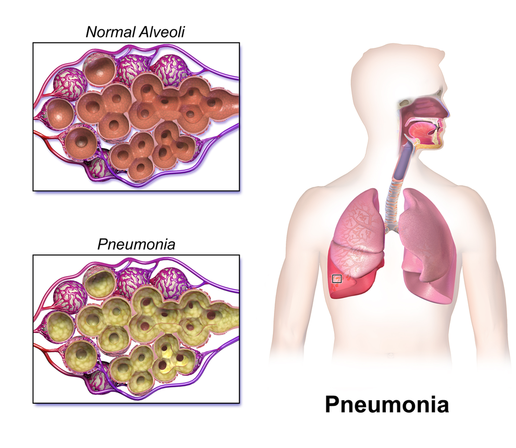 pneumonia pneumonia
