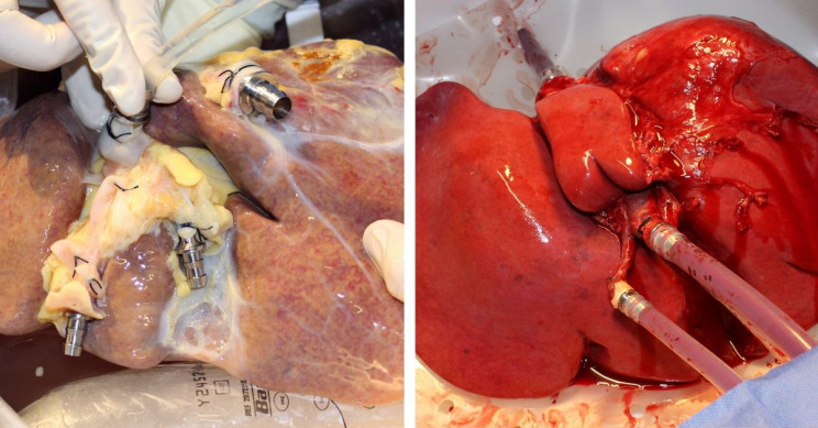 Scientists Build Machine That Keeps Human Livers Functioning outside of the Body for 1 Week