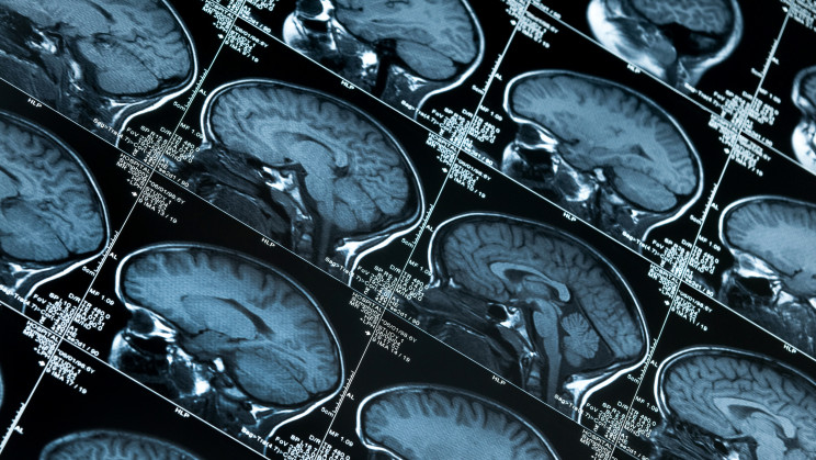 Scientists take another important step to solve the mystery of Alzheimer's