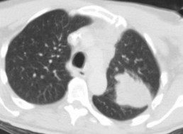 Google's Medical AI Detects Lung Cancer With 94% Accuracy