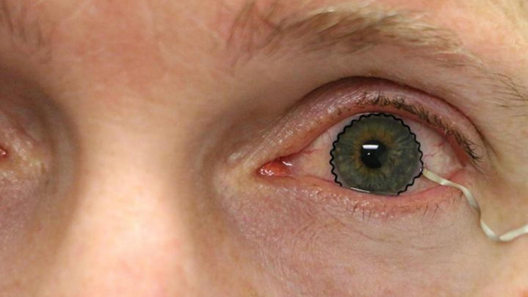 New Soft Contact Lens Diagnoses and Monitors Eye Diseases New Soft Contact Lens Diagnoses and Monitors Eye Diseases