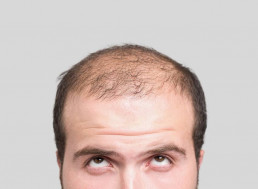 Reversing Baldness With an Electric Hat