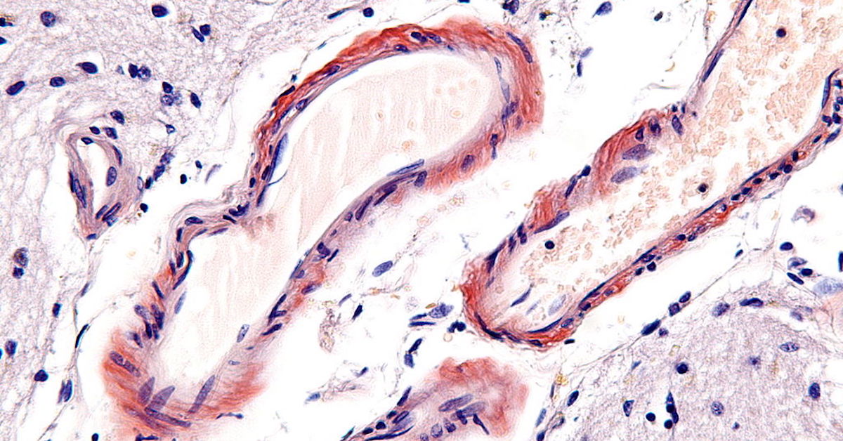 ISS's Microgravity is Ideal to Study Alzheimer's Protein ISS's Microgravity is Ideal to Study Alzheimer's Protein