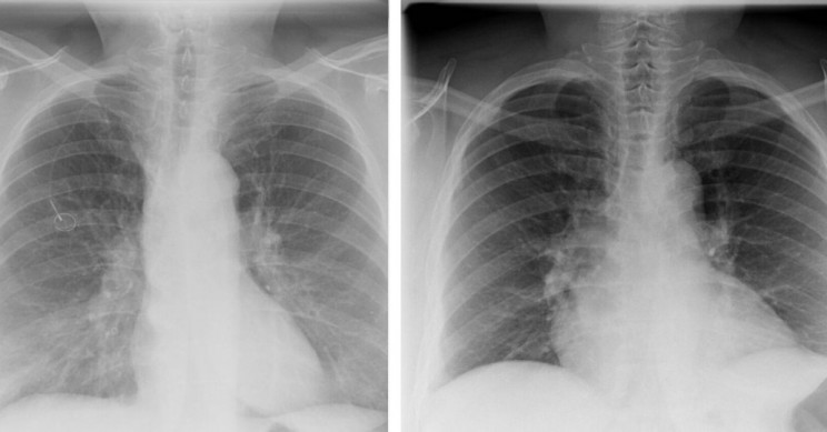 Lab-Grown 'Mini Lungs' Are Helping Scientists Understand COVID-19 Infection