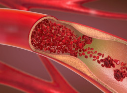 New Nanoparticle Eats Away At Heart Attack Causing Plaques