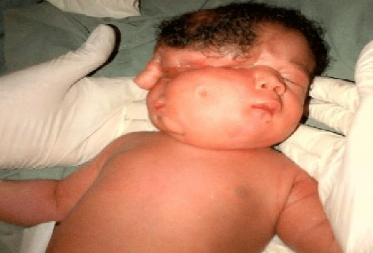 genetic conditions diprosis