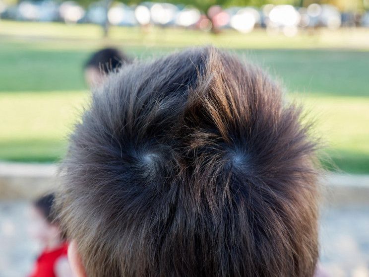 genetic conditions mohawk