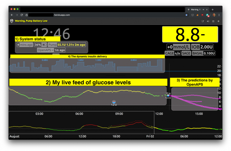 Software Engineer with Diabetes Incredibly Builds His Very Own Artificial Pancreas Software Engineer with Diabetes Incredibly Builds His Very Own Artificial Pancreas