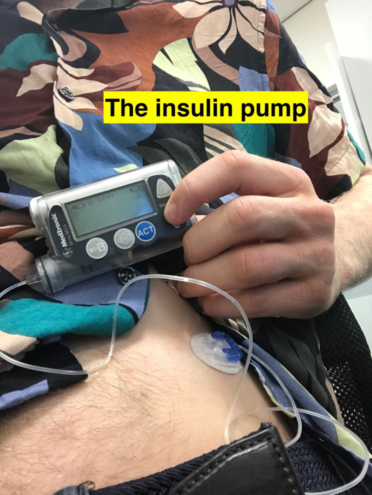 Software Engineer with Diabetes Incredibly Builds His Very Own Artificial Pancreas Software Engineer with Diabetes Incredibly Builds His Very Own Artificial Pancreas