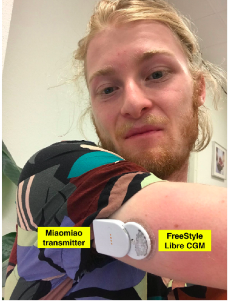 Software Engineer with Diabetes Incredibly Builds His Very Own Artificial Pancreas Software Engineer with Diabetes Incredibly Builds His Very Own Artificial Pancreas