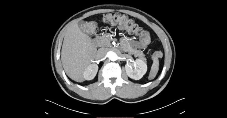 New Machine Learning Tool Detects Hard-to-Spot Tumors