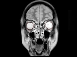 What Happens To Your Brain When You Drink 50 Beers Daily for 6 Weeks