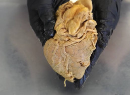 You Can Actually Die From a Broken Heart